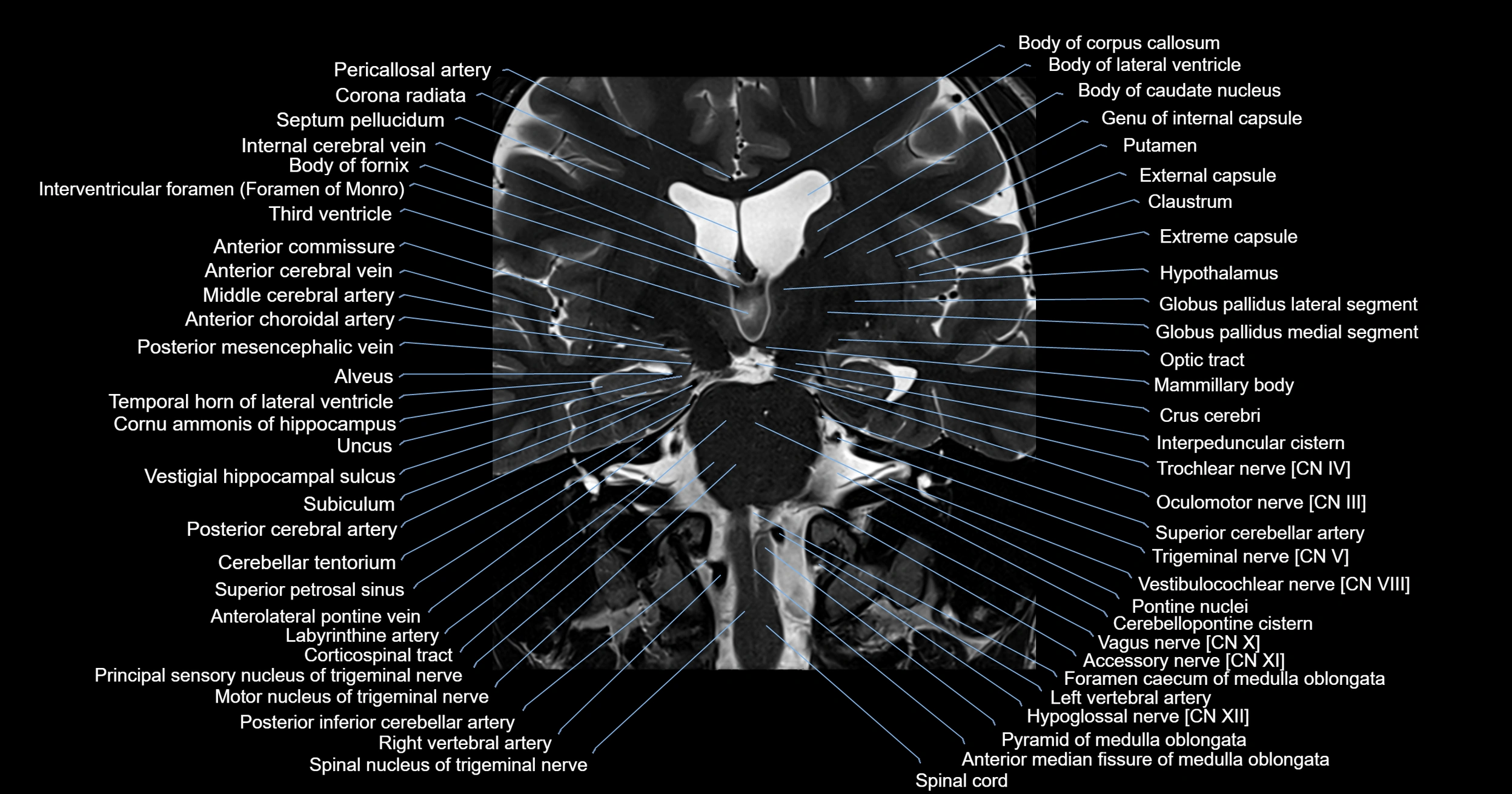 MRI brainstem & basal ganglia anatomy labelled 3T MRI images -img-00001-00019.webp
